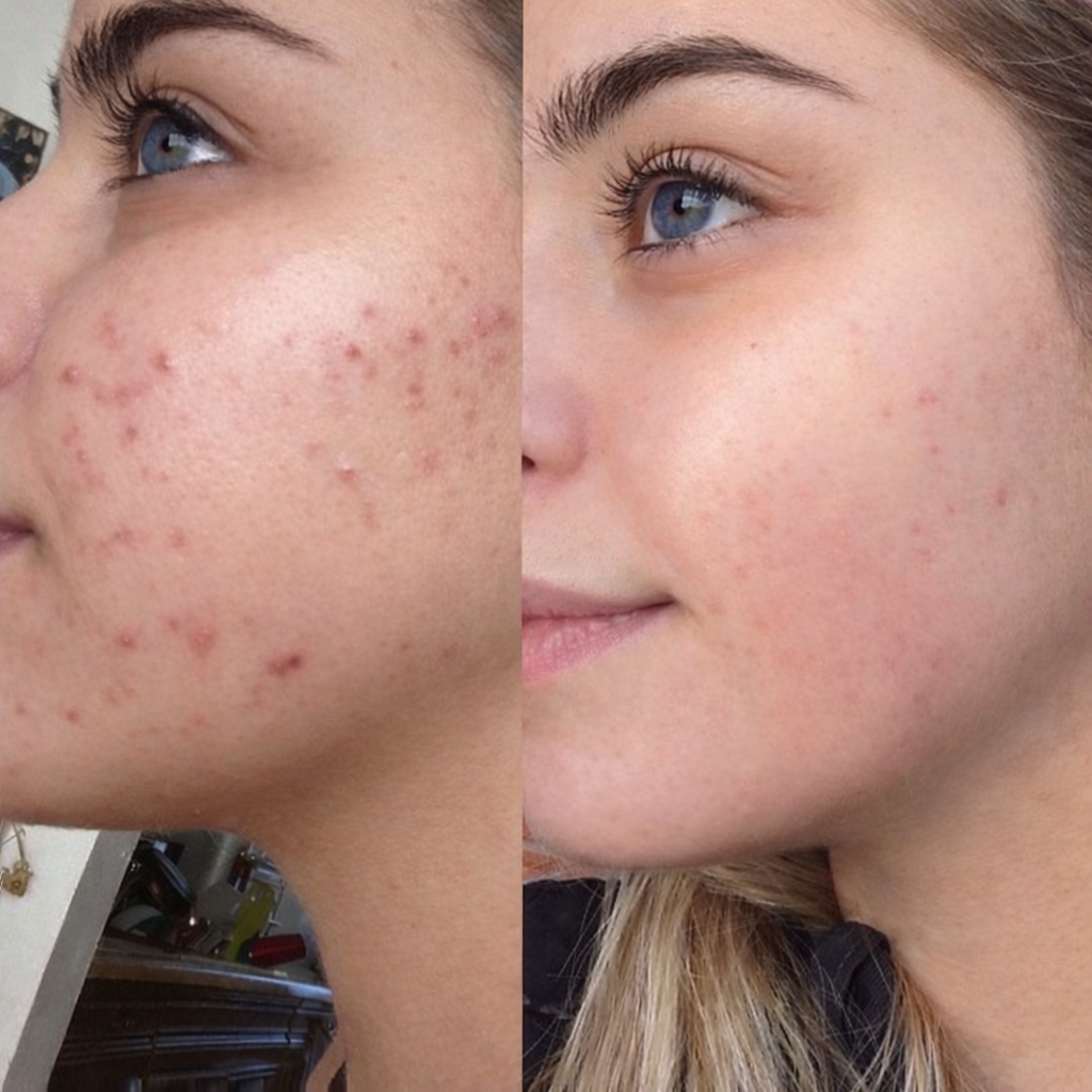 Before & After foto 3